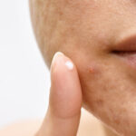 Como quitar marcas de acne